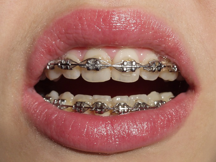 Dentage Bondage