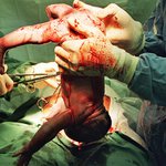 Stříhání pupeční šňůry